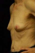 Breast Augmentation, Gel