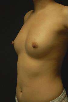 Breast Augmentation, Gel