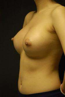 Breast Augmentation, Gel