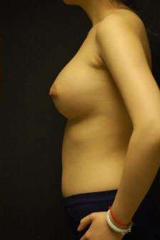 Breast Augmentation, Gel