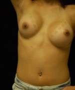 Breast Augmentation Revision