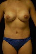 Breast Augmentation Revision