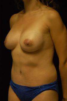 Breast Augmentation Revision