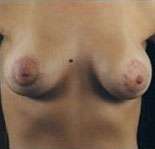 Mastopexy