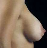 Mastopexy