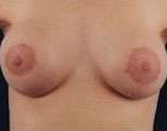 Mastopexy