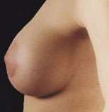 Mastopexy