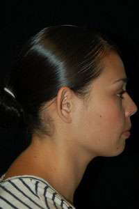 Otoplasty-Ear pinning