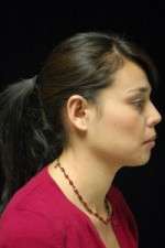 Otoplasty-Ear pinning