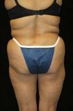 Smartlipo Triplex Laser Liposuction