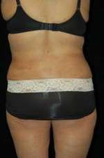 Smartlipo Triplex Laser Liposuction