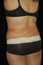 Smartlipo Triplex Laser Liposuction