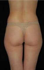 Smartlipo Triplex Laser Liposuction