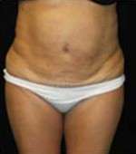 Smartlipo Triplex Laser Liposuction