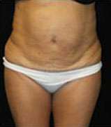 Smartlipo Triplex Laser Liposuction