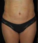 Smartlipo Triplex Laser Liposuction