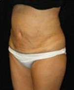 Smartlipo Triplex Laser Liposuction