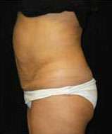 Smartlipo Triplex Laser Liposuction