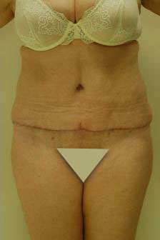 Abdominoplasty