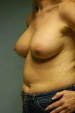Breast Augmentation, Gel