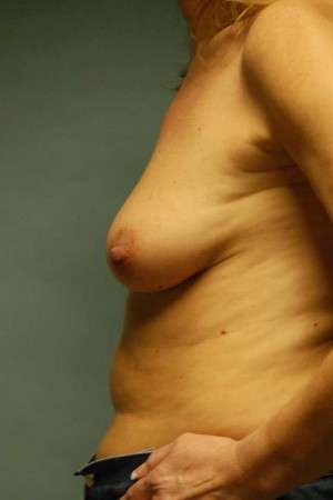 Breast Augmentation, Gel