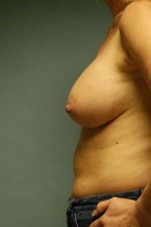 Breast Augmentation, Gel