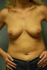 Breast Augmentation, Gel