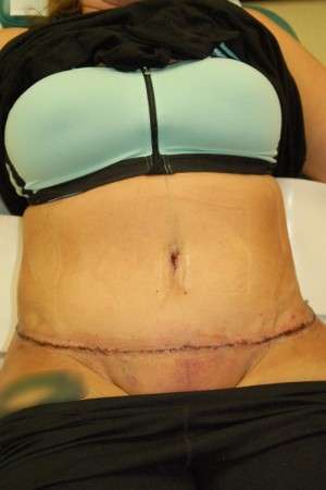 Abdominoplasty