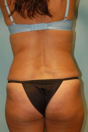 Abdominoplasty Case 3791 After Photo Abdominoplasty