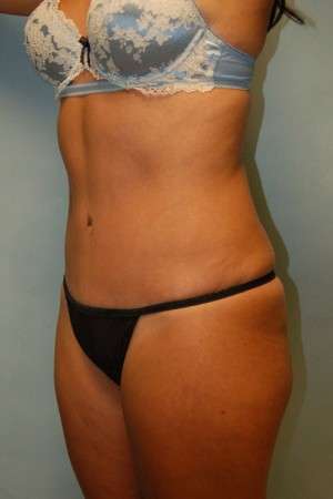 Abdominoplasty Case 3791 After Photo Abdominoplasty