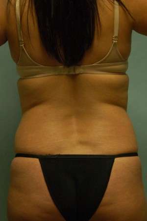 Abdominoplasty Case 3791 Before Photo Abdominoplasty