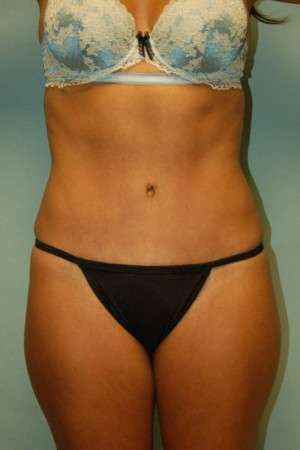 Abdominoplasty Case 3791 After Photo Abdominoplasty