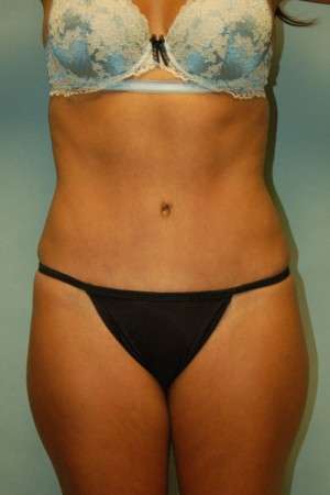 Abdominoplasty