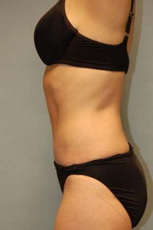 Abdominoplasty Case 3938 After Photo Abdominoplasty