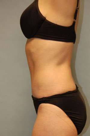 Abdominoplasty