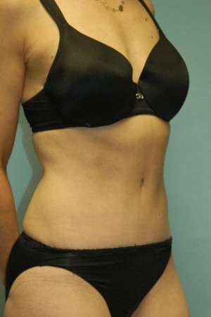 Abdominoplasty Case 3938 After Photo Abdominoplasty