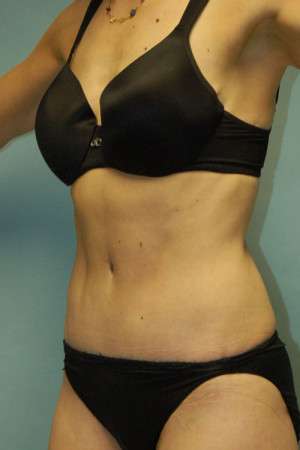 Abdominoplasty Case 3938 After Photo Abdominoplasty