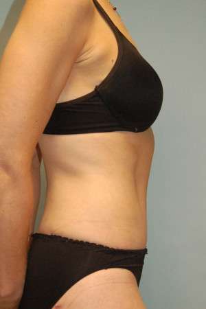Abdominoplasty Case 3938 After Photo Abdominoplasty