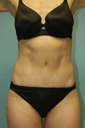 Abdominoplasty Case 3938 After Photo Abdominoplasty