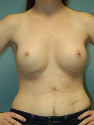 Breast Augmentation Revision