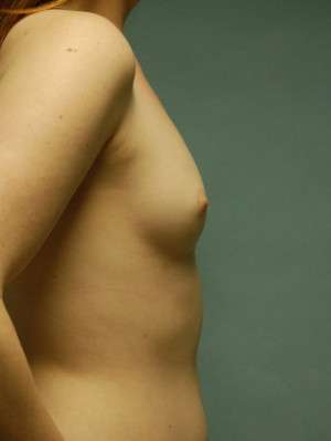 Breast Augmentation Revision Case 4643 Before Photo Breast Augmentation Revision