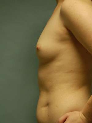 Breast Augmentation Revision