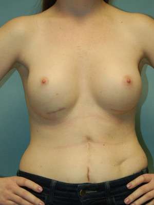 Breast Augmentation Revision