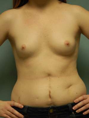 Breast Augmentation Revision