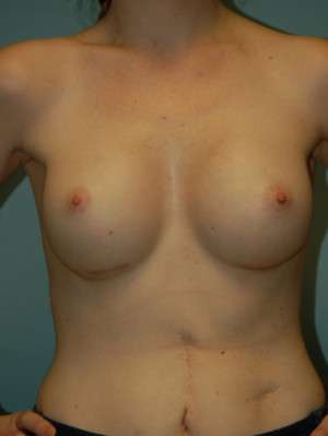 Breast Augmentation Revision