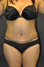 Abdominoplasty