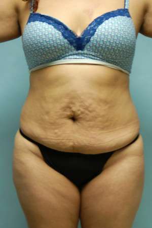 Abdominoplasty