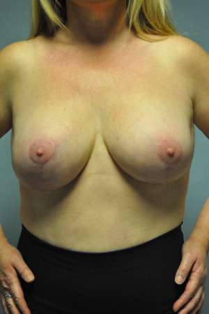 Breast Augmentation Revision Case 4672 After Photo Breast Augmentation Revision