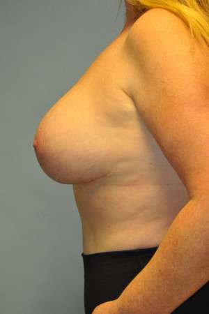 Breast Augmentation Revision Case 4672 After Photo Breast Augmentation Revision