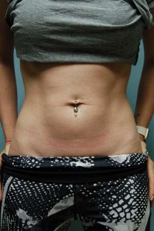 SculpSure™ Fat Removal Case 4619 Before Photo SculpSure™ Fat Removal
